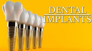 Common questions asked about dental implants