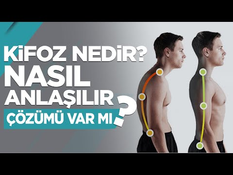 Kifoz Nedir? Nasıl Anlaşılır? Çözümü Var mı?