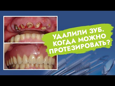 Удалили зуб. Когда можно протезировать?
