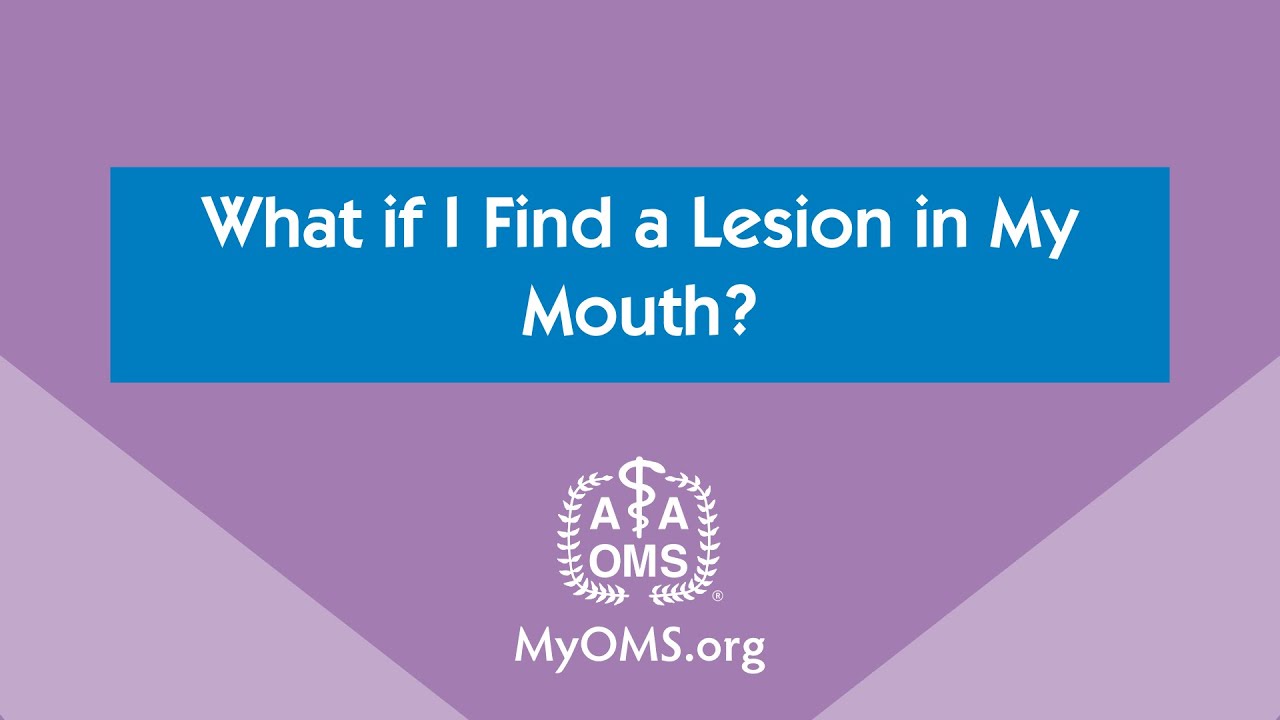 What if I Find a Lesion in My Mouth?