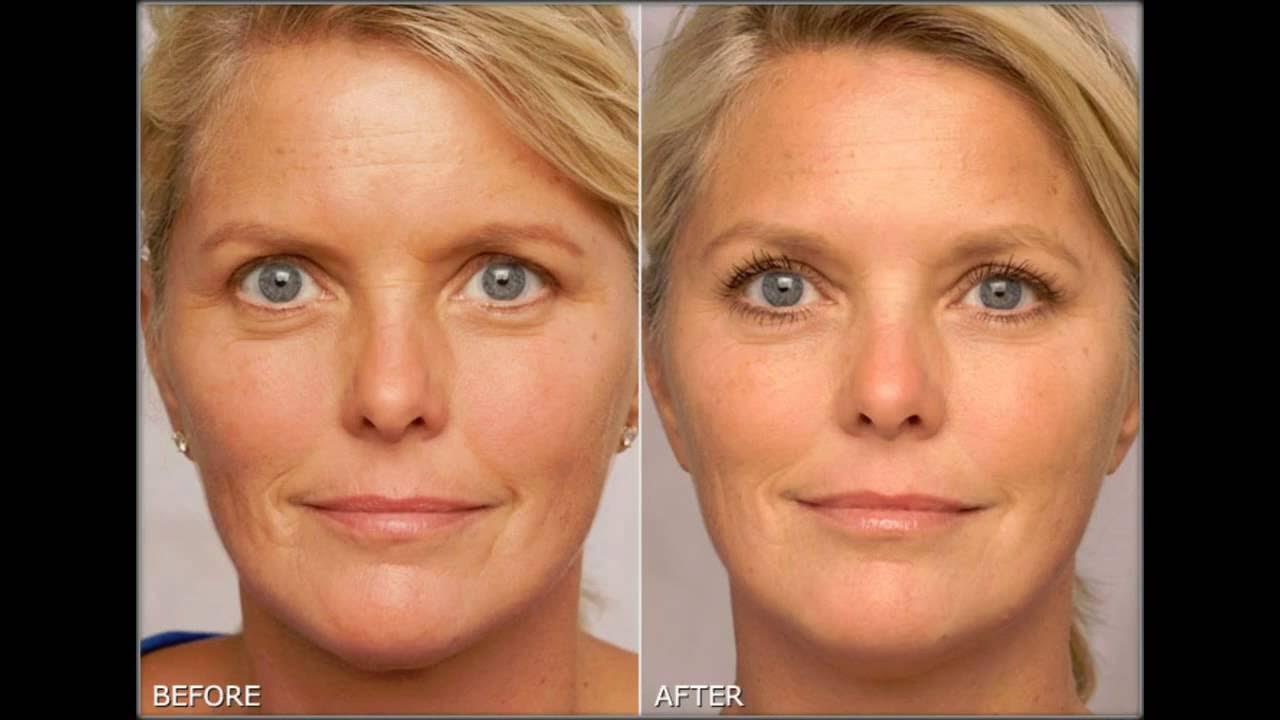 активная мимика. Expression lines. кисетные морщины ботокс. инъекции ксеомина. лицо.