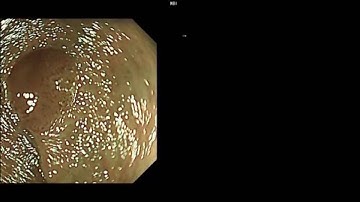 Characterization of Colorectal Lesions Using a Computer-Aided Diagnostic System...