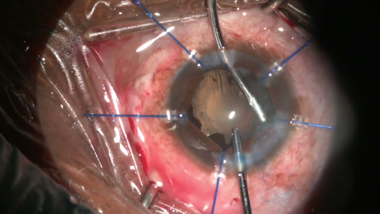 Uveitic cataract with iris hooks