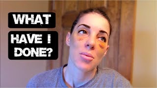 Do I Regret Getting a Nose Job Profile