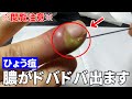 【閲覧注意】指先が大変なことになったので膿だしします【ひょう疽】