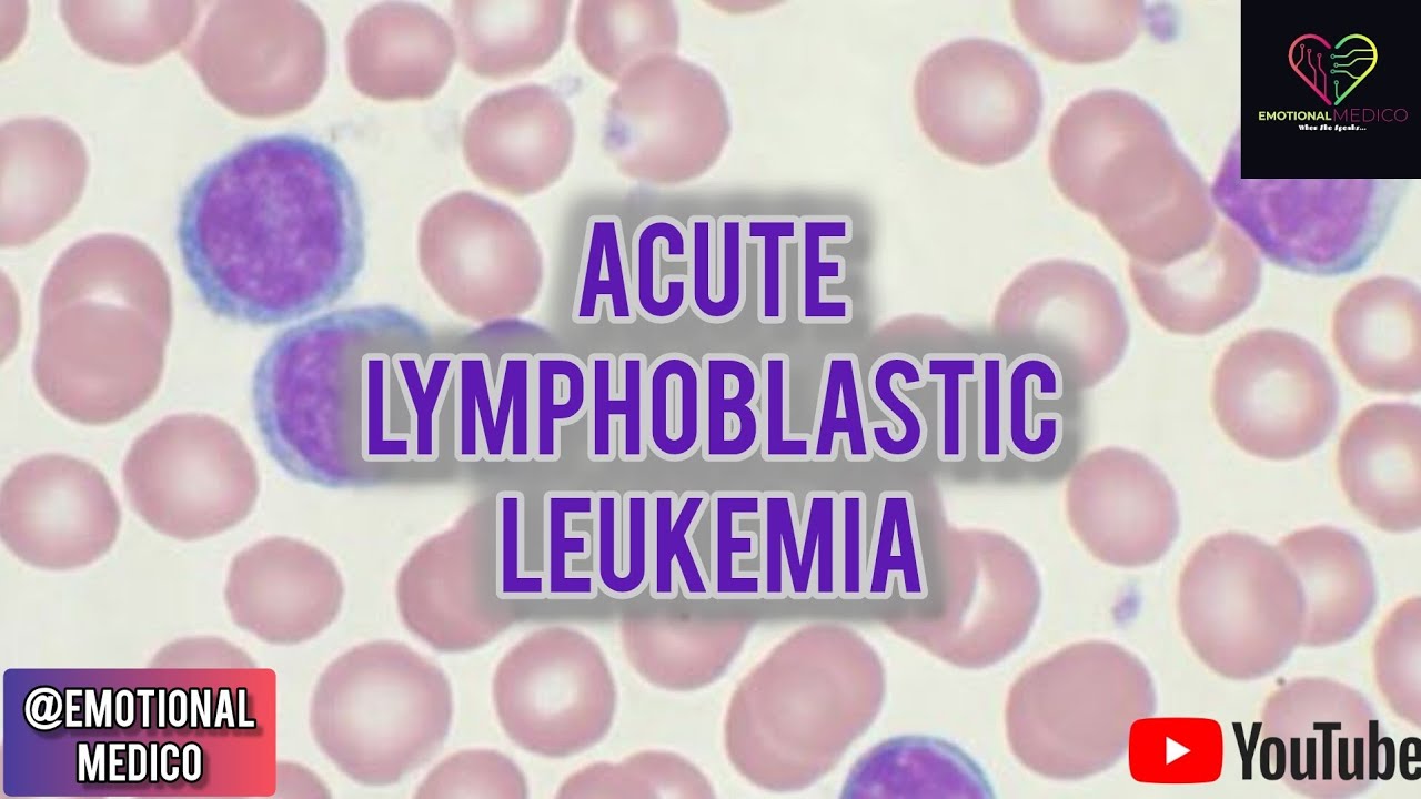Acute Lymphoblastic Leukemia | Pediatrics | Must know points ...