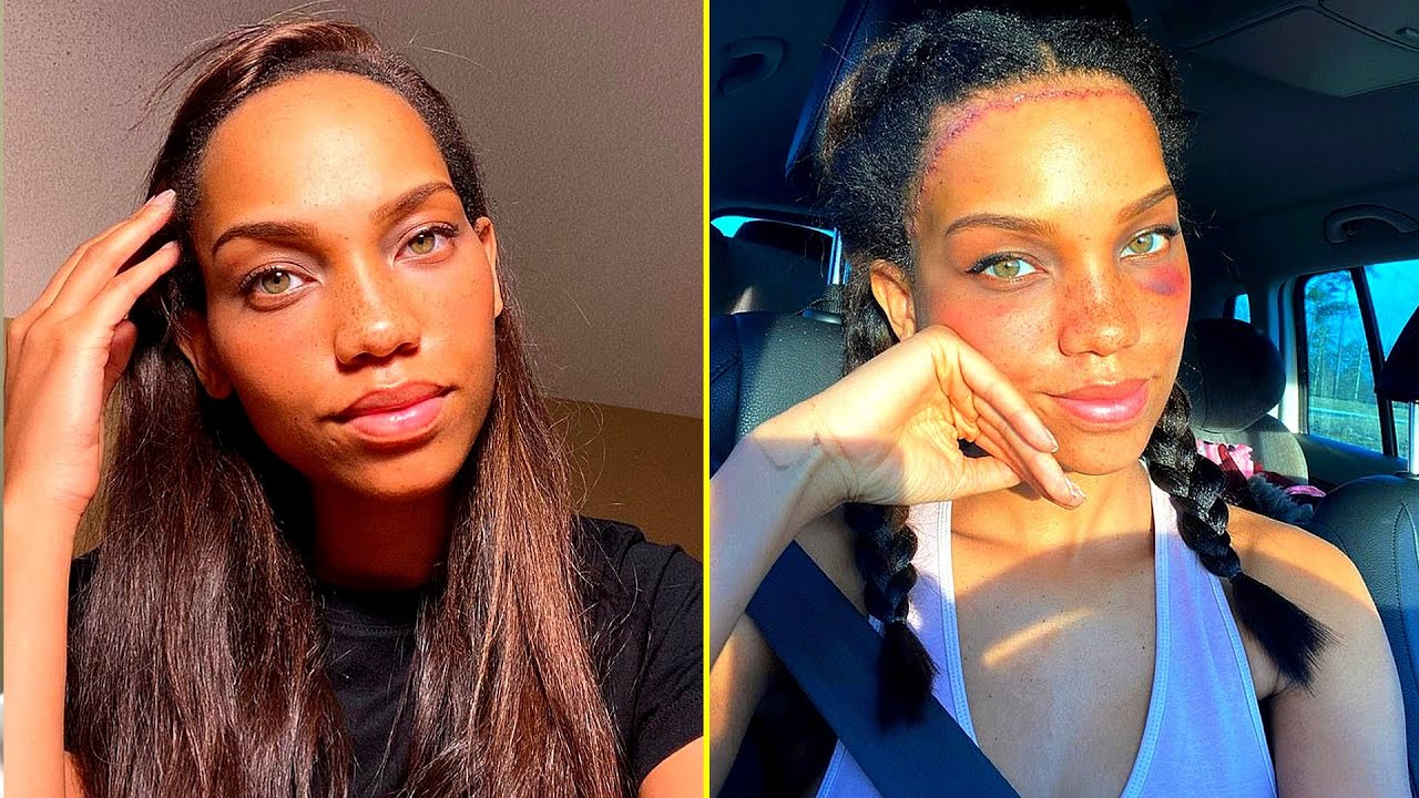 MODELO realiza CiRURGiA POLÊMICA de REDUÇÃO DE TESTA e RECEBE CRÍTICAS