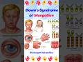 Down’s Syndrome is not a flaw, it’s a unique spark. ✨ #downsyndrome   #geneticdisorders #biology