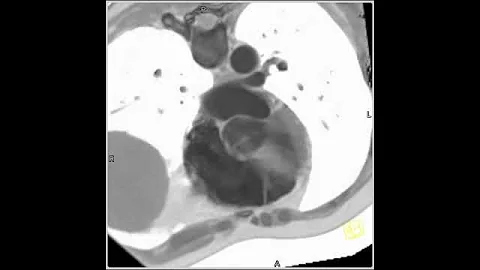 4D Imaging of the Aortic Valve: Bicuspid valve (1 of 2)