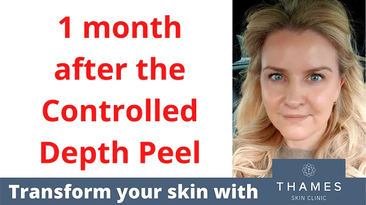 Results time following Kate's Controlled Depth Peel