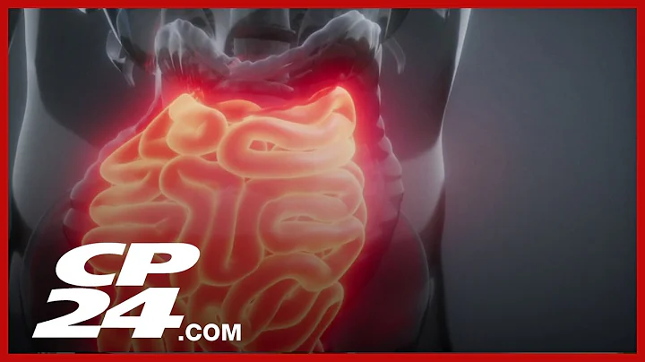 New treatment option for Crohn’s Disease