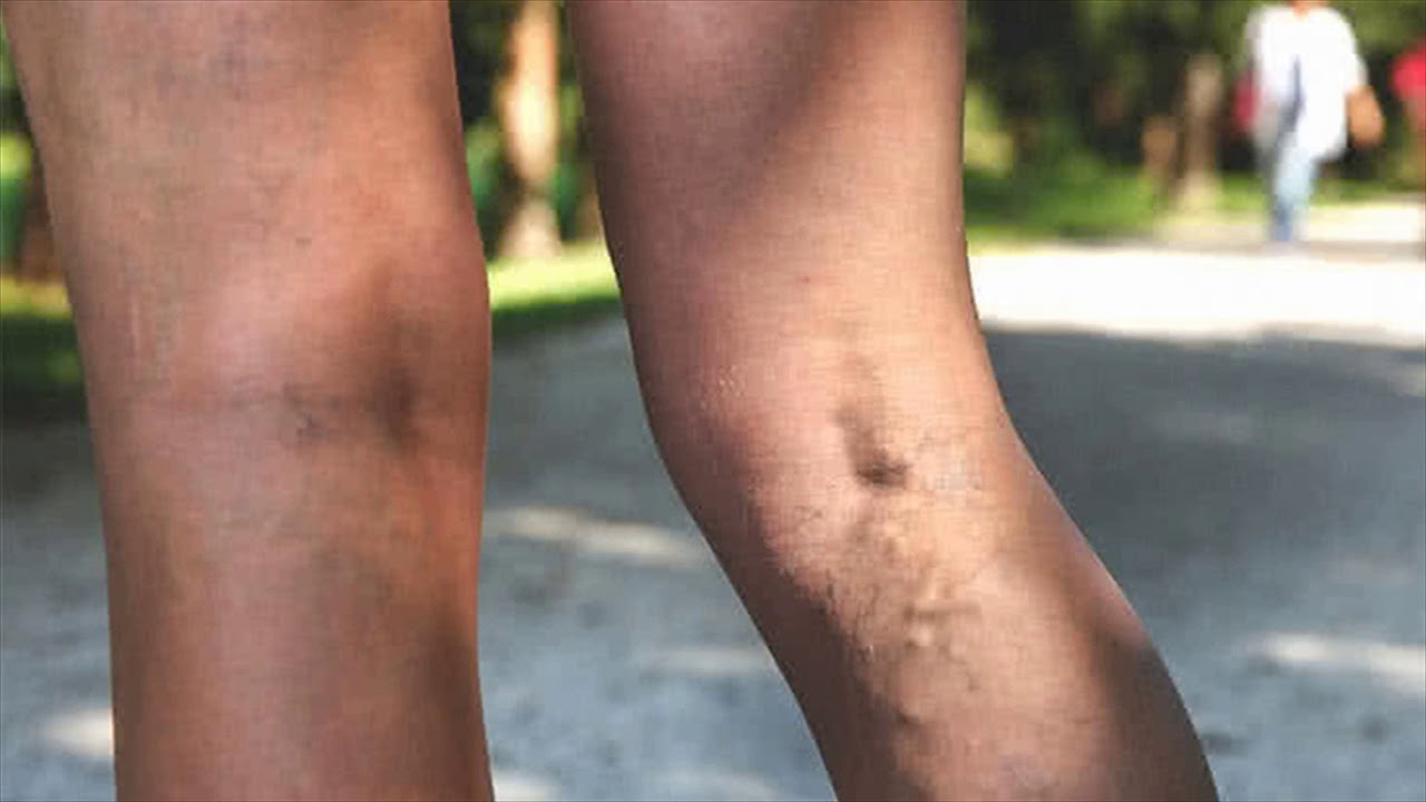 Use Hot Tubs With Essential Oils To Treat Shin Splint - Effective