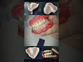 Complete Denture #shorts