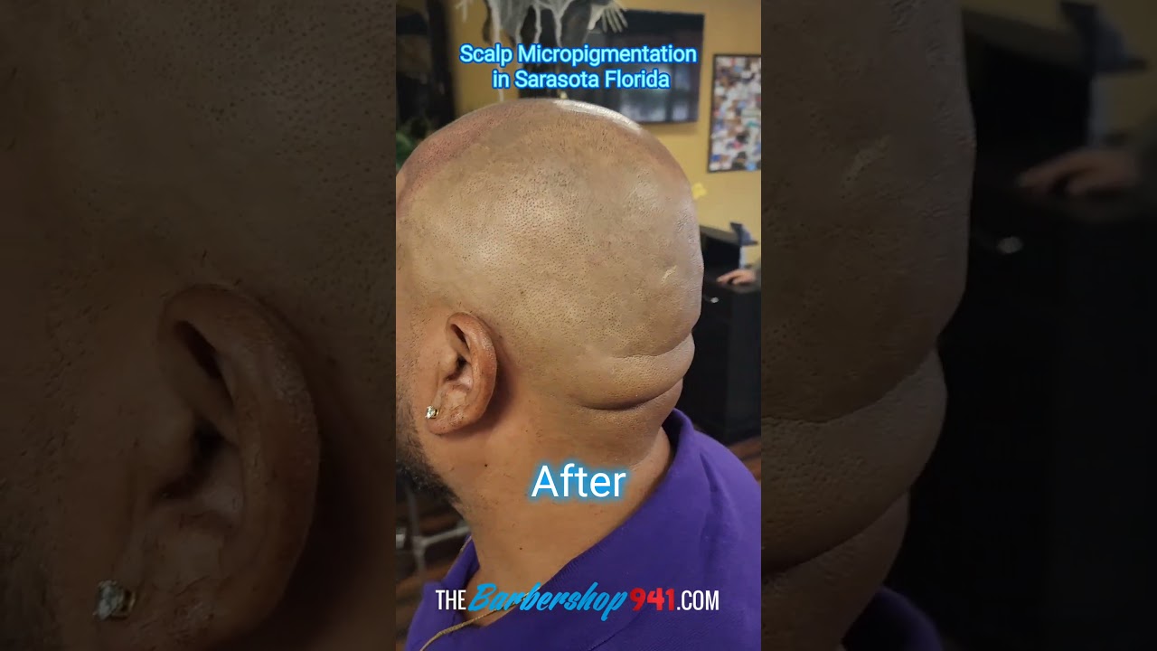 Restoring Hairlines: Scalp Micropigmentation in Sarasota Florida! #sarasota #barber #hairline #smp