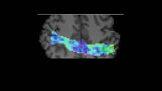 Zoom MRSI, Human Brain Metabolic Neurochemical Atlas Zoom MRSI