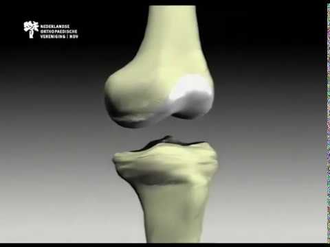 Video: Behandeling Van Artrose Met Kruiepreparate