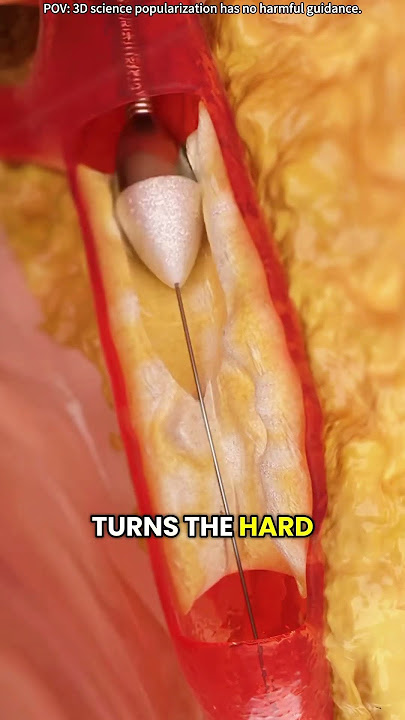 How rotational atherectomy is performed?