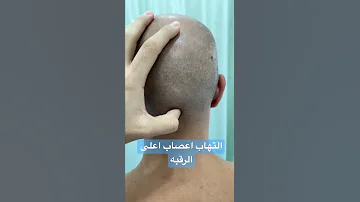 التهاب اعصاب اعلى الرقبه Abualiphysio 
