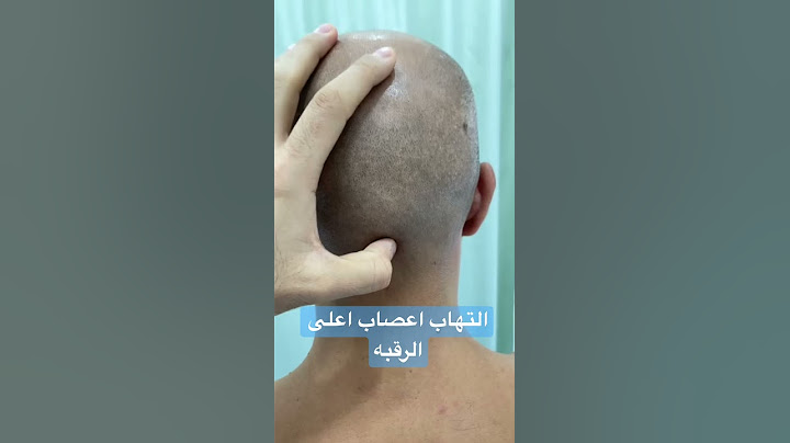التهاب اعصاب اعلى الرقبه #abualiphysio