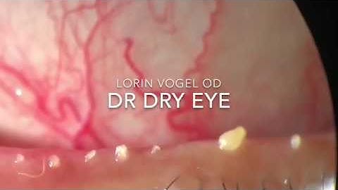 Meibomian gland dysfunction / IPL @ Dry Eyes Los Angeles