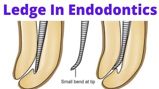 Master bypassing ledges #endodontics Mishaps #bypassing ledge 