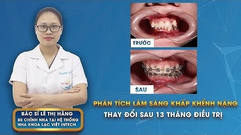NIỀNG RĂNG KHẤP KHỂNH, KHỚP CẮN ĐỐI ĐẦU THAY ĐỔI SAU 13 THÁNG - PHÂN TÍCH TỪ CHUYÊN GIA