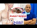 علاج جرثومة المعدة و التهاب المعدة من المنزل/ اعراض جرثومة المعدة و العلاج/ التشخيص/