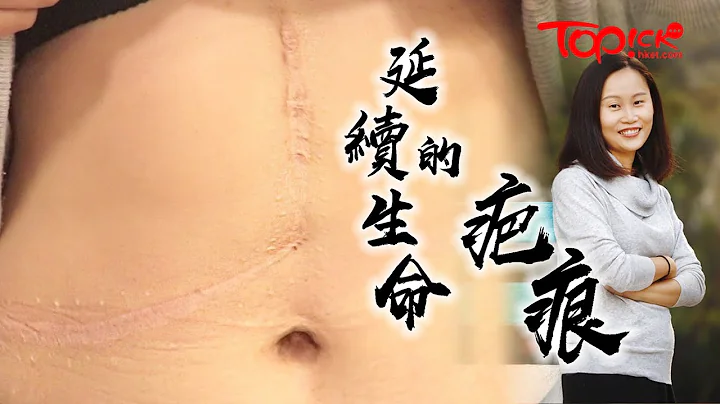 【#TOPick健康】9年前捐肝救人留大疤痕　老師如今成三孩之母：不捐會後悔一生 - 天天要聞