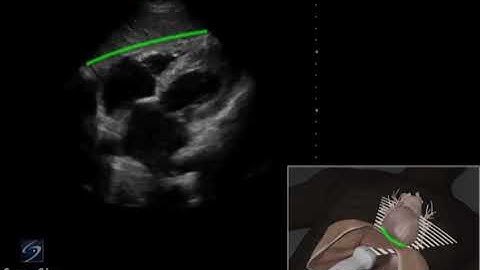 6. How To EFAST Subxiphoid View 3D Video _ Sonosite.