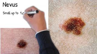 Nevus - Moles.  Which nevi are dangerous? Freckles and moles are  the same?