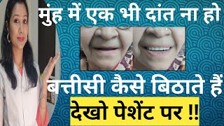 एक भी दांत ना हो तो बत्तीसी कैसे बिठाते हैं?  |Battisi Kaise Bithate He Dekhe Patient Pe |Battisi