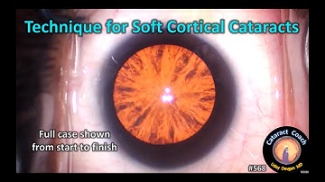 Complete Cataract Case: Technique for Soft Cortical Cataracts