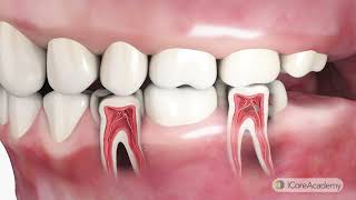 Bridging the Gap | Essential Post-Op Instructions for Bridge Care