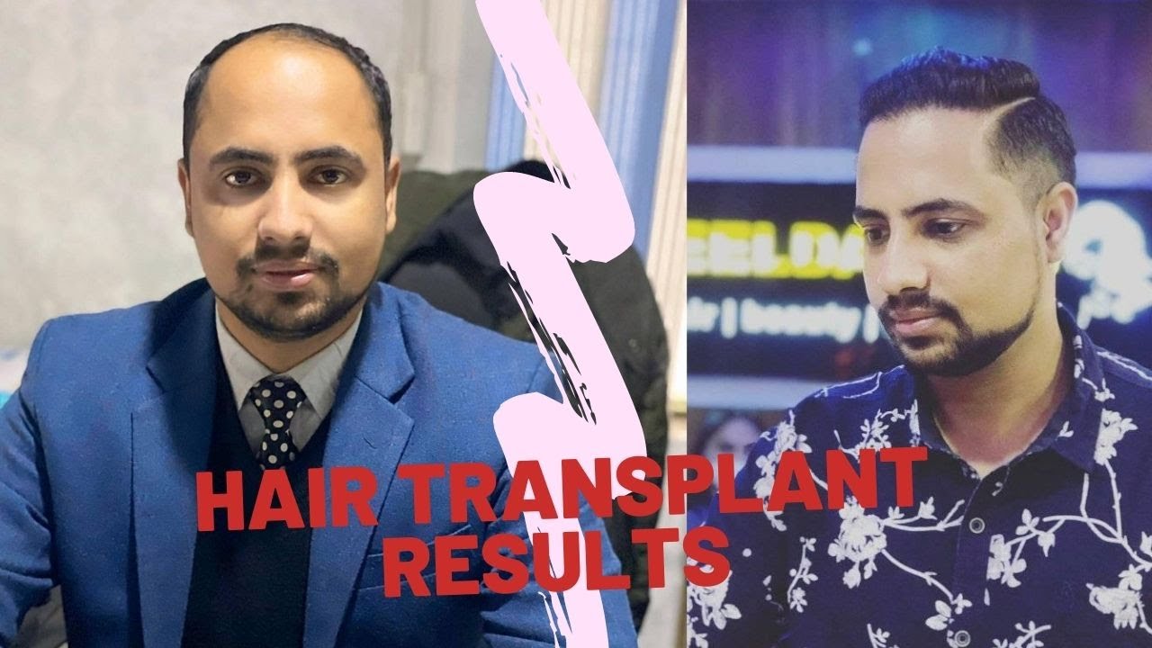 hair transplant in Nepal result and testimonial YouTube