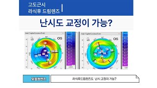 라식후드림렌즈에서 난시도 교정이 가능할까요?