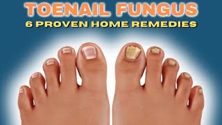 Revitalize Your Toenails: 6 Proven Home Remedies for Toenail Fungus Elimination - 2024