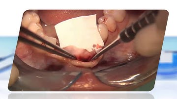 Geistlich Bio-Gide® Handling Video