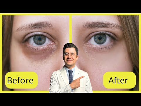 علاج الهالات والانتفاخات في يوم واحد فقط