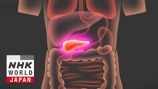 Destroying Pancreatic Cancer with Ultrasound  Medical Frontiers