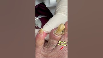 Part 1: Most Curved Toenails Ever! Thick Nail Cutting Transformation #satisfyingshorts #nailcutting