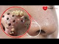 Remove Blackheads From The Nose Permanently In Minutes