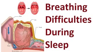 Methods to Improve Breathing Difficulties During Sleep by Prof John Mew