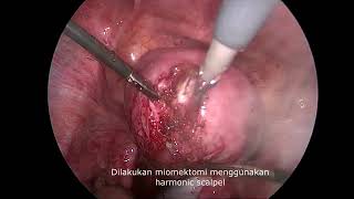 Use of a foley catheter as a tourniquet to prevent bleeding during laparoscopic for uterine fibroid