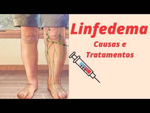 Vídeo: Disfunção Linfática (Linfedema): Sintomas E Tratamentos