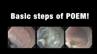 Basic Steps of POEM!