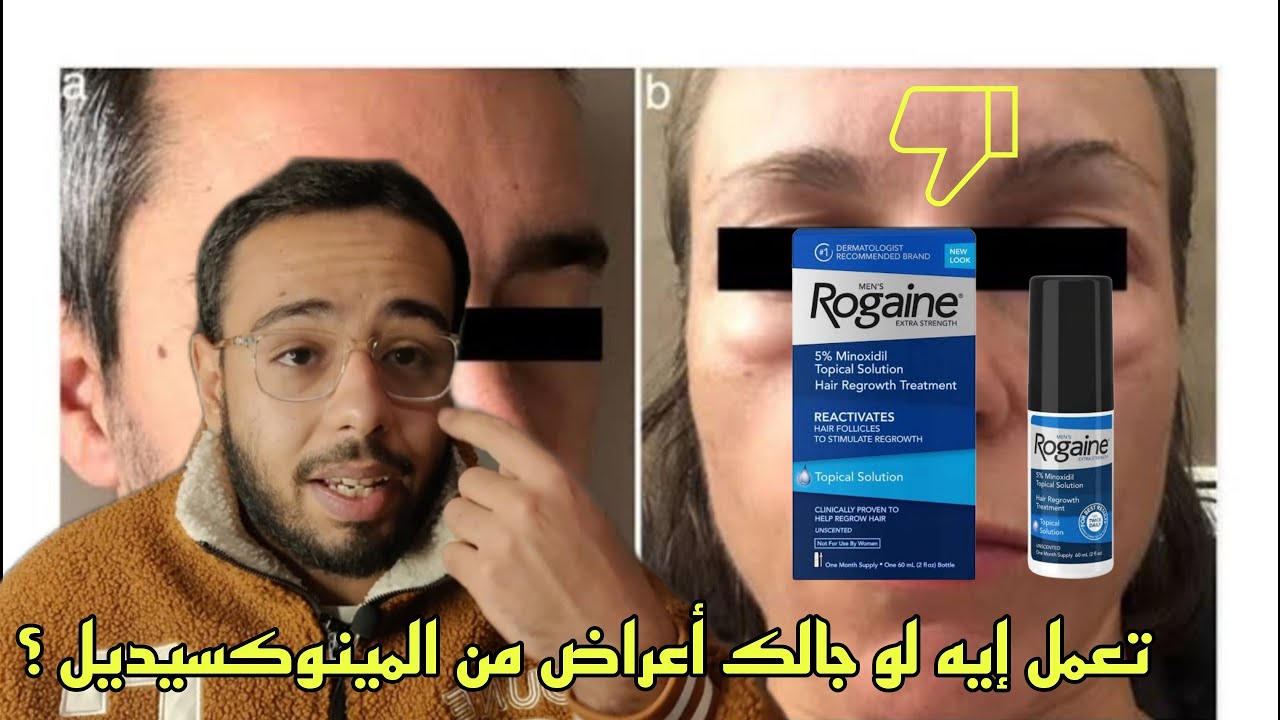 تعمل إيه لو جالك أعراض جانبية من المينوكسيديل ؟