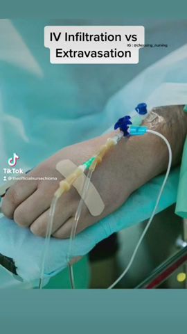 Webmedcentralcom A Silent Chemotherapy Extravasation