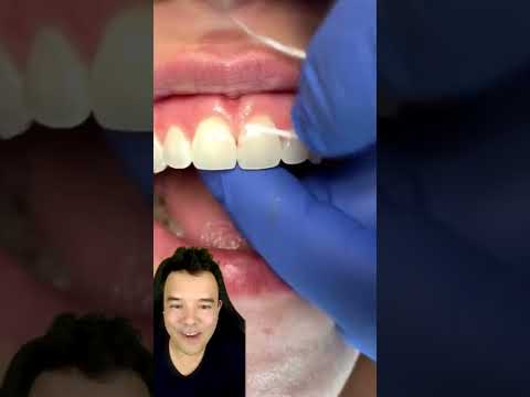 Vídeo: 3 maneiras de limpar dentes manchados de nicotina