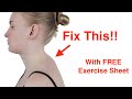 Easy Fix for the Neck Hump! (With FREE Exercise Sheet!)