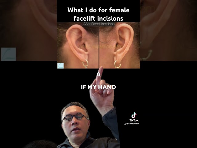 What I do for female facelift incisions
